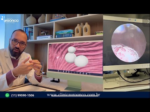 Bexiga | Nem toda Imunoterapia serve para você | A verdade sobre o Nivolumab e BCG