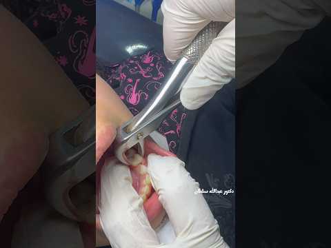 Extraction of primary teeth 🦷 #dr_abdullah_sultan_dentist #dentist #اكسبلور