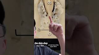 #onthisday #brain eating #amoeba #education #pathology