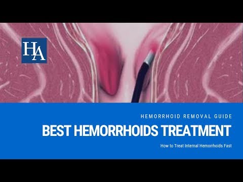 Best Internal Hemorrhoids Treatment | How to Treat...