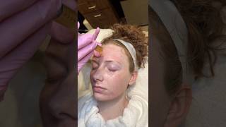 🎬✨ SkinPen Microneedling + PRP in action ✨