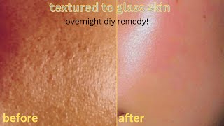 HOW TO GET RID OF TEXTURED SKIN & TINY BUMPS ON FACE OVERNIGHT [Diy Face Mask]