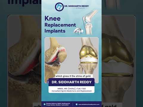 Total Knee Replacement Implants Explained | Dr. Siddharth Reddy 🦵