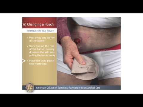Colostomy/Ileostomy: Changing a Pouch