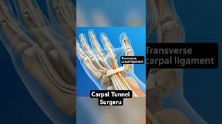 Inside Carpal Tunnel Release Surgery