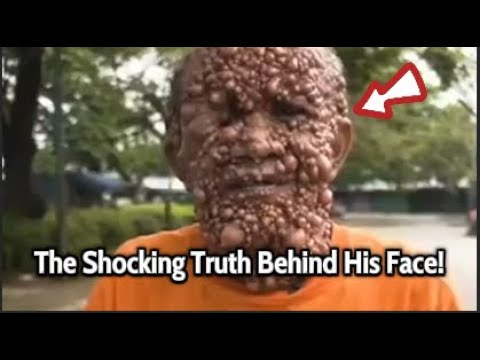 The Man Who Lived with Tumors on His Face for 59 Years! #truestory