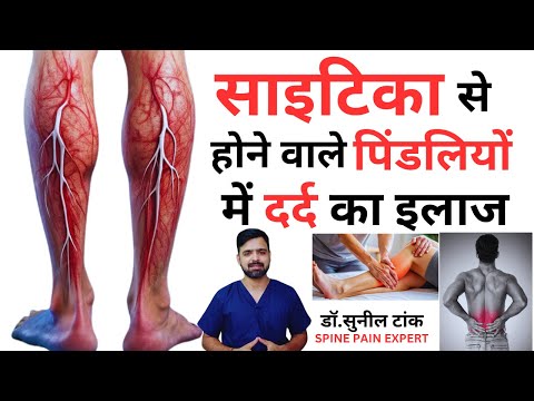 साइटिका से होने वाले पिंडलियों में दर्द का इलाज | Pindliyo ka dard kaise theek karen | calf pain