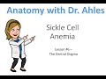 Sickle Cell Anemia Concepts