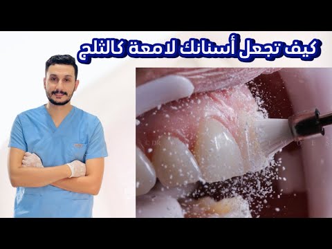 تلميع الأسنان من الصبغات || حل مشكلة تصبغات الأسنان ||تبييض الأسنان #dr_abdullah_sultan_dentist