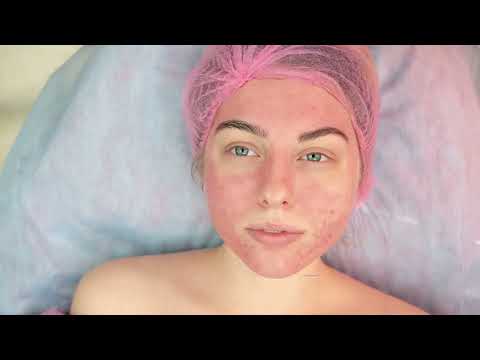 Top 5 At-Home Acne Solutions: Clear Skin in No Time!