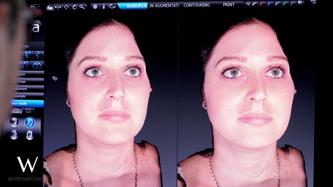 3D facial analysis for rhinoplasty assessment.