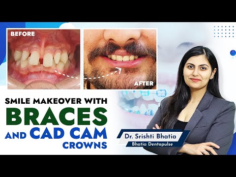 Smile Makeover with BRACES and CAD CAM crowns: Dr. Srishti Bhatia #smile #smilemakeover