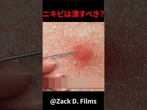 ニキビは潰すべき? #shorts