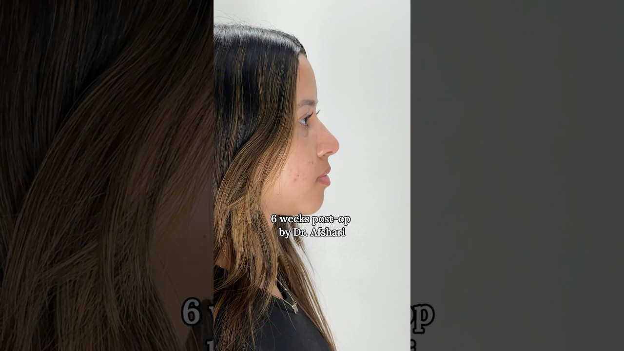 Profile view of woman six weeks post-surgery.