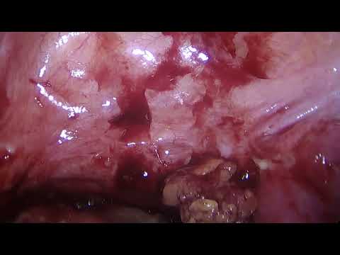Drenagem de abscesso pélvico e liberação de aderencias/ Pelvic abscess drainage and adhesion release