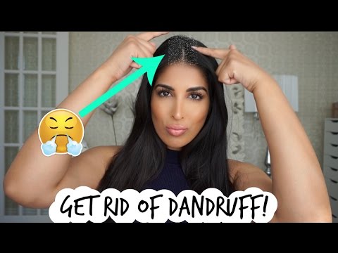 HAIR HACK! GET RID OF DANDRUFF FAST!