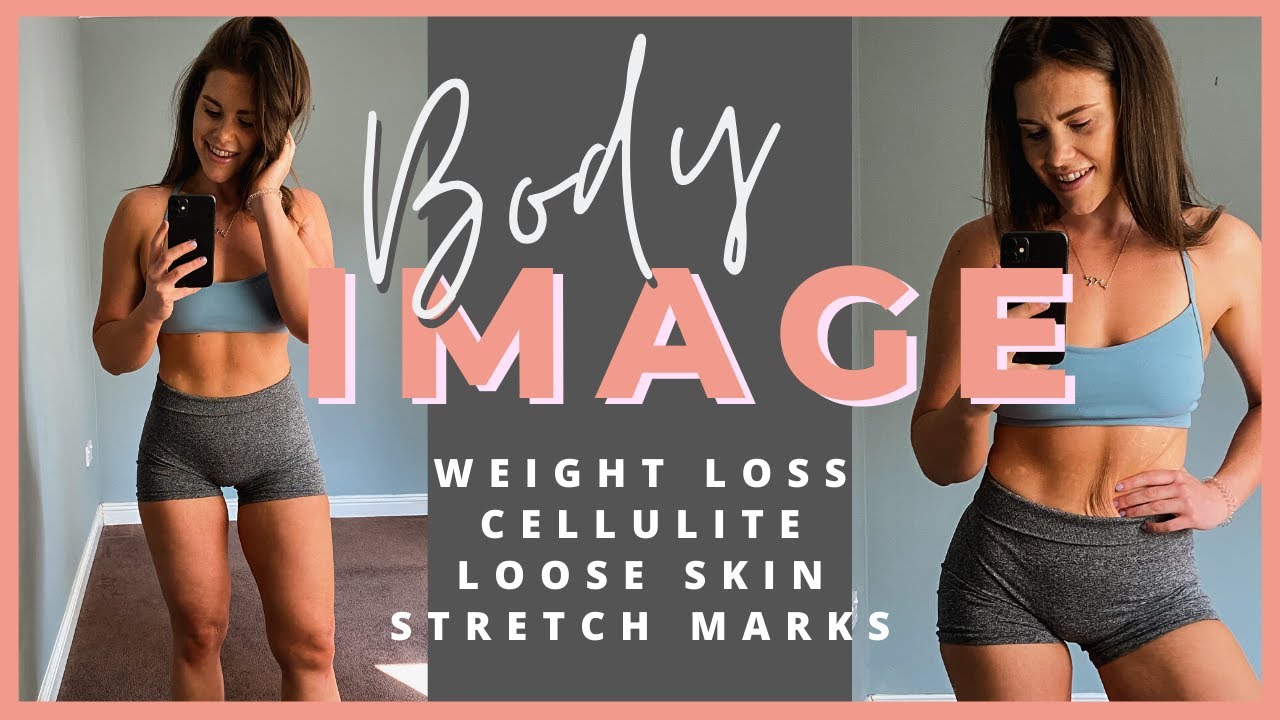 Let's Talk Body Image: 30kg Weight Loss Loose Skin, Stretch Marks, Cellulite, Psoriasis & Confidence