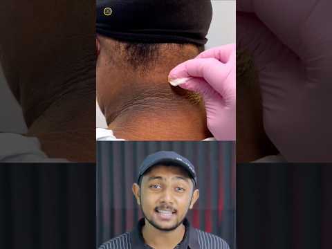 Acanthosis nigricans