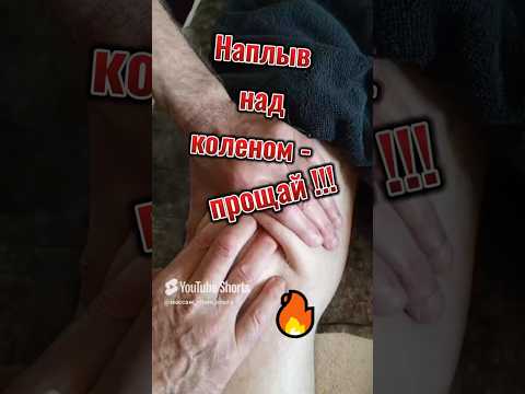 🔥Наплыв над коленом - прощай!#наплыв_над_коленом#колено#flood_over_the_knee#knee_pain#shorts