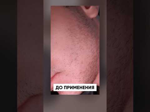 БУСТ ДЛЯ БОРОДЫ: вот так работает ксиноксин 15%