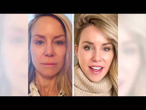 How this 58 year old looks like she is 30! Two Year Facelift and Lip Lift transformation #shorts