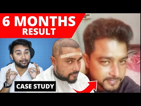 My Full Hair Transplant Journey Of 6 Months | My Hair Transplant Cost Of 4000 Grafts 2025