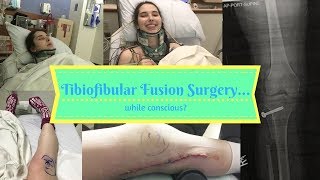 Vlogging with EDS: I WAS AWAKE THE ENTIRE SURGERY! - Tibiofibular Fusion | Week 74
