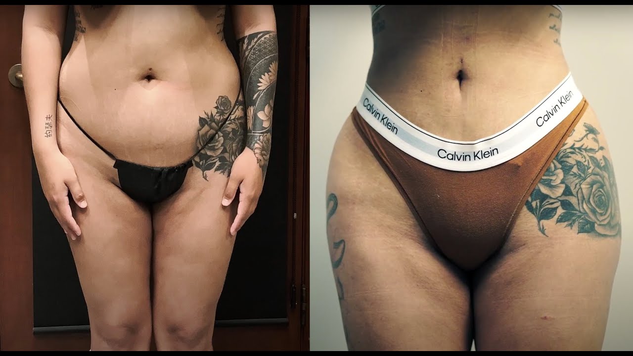 Liposuction 360 BBL WITH Post Op Results