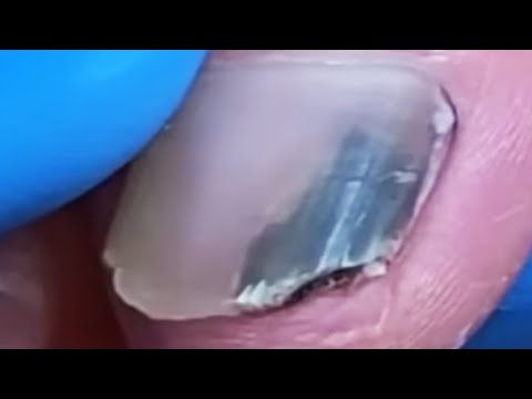 Step by step - So much dirt under nail 【辥一刀】