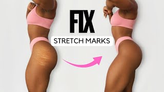 FIX STRETCH MARKS NATURALLY – At-Home Routine! 