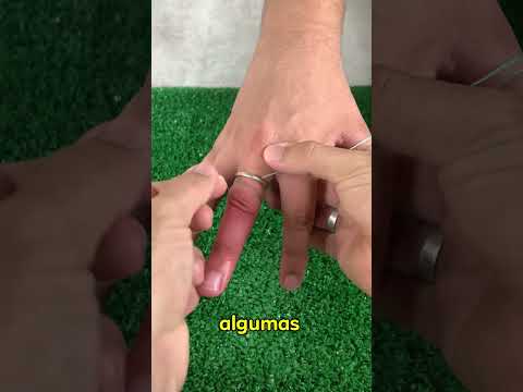 Um enfermeiro me ENSINOU como remover o anel PRESO no dedo!