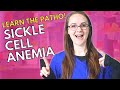 Sickle Cell Anemia Concepts