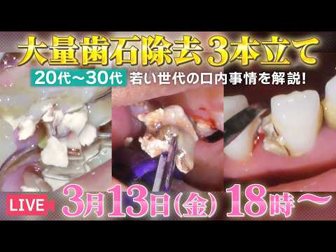 大量歯石除去3本立て🦷若い世代の口内事情を解説‼️