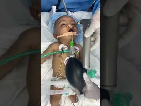 Final steps of pediatric anesthesia #shorts #baby