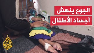 تفاقم حالات سوء التغذية بين أطفال غزة