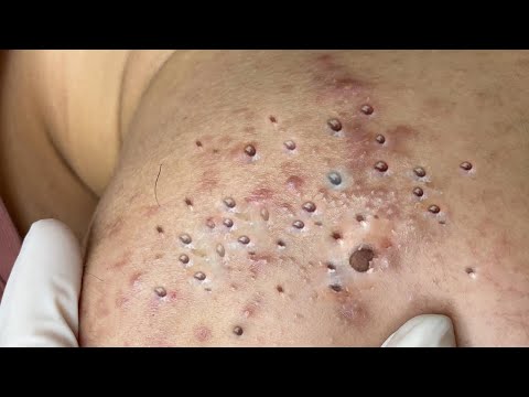 Big Cystic Acne Blackheads Extraction Blackheads & Milia, Whiteheads Removal Pimple Popping # 431