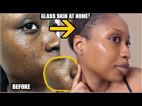 HOW TO CLEAR ACNE TEXTURED SKIN FOR GOOD OVERNIGHT | GLASS SKIN NATURAL MASK SKINCARE ROUTINE 2025