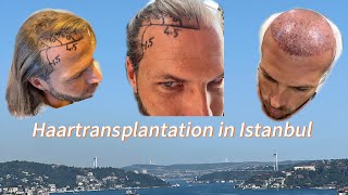 Haartransplantation in Istanbul 