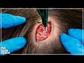 Neuralink Technology and Applications