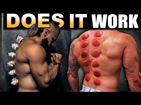 The WORST PAIN ❗️ Testing CUPPING THERAPY On Raw BACK/SPINAL INJURY (Does it Really Work?!)