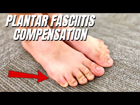 What's the Secret to Beating Plantar Fasciitis for Good? Finding Compensations