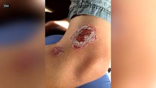 YouTube video thumbnail: Maryland Warns Swimmers About Flesh-Eating Bacteria in Chesapeake Bay Waters