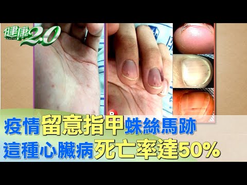 疫情期間留意”指甲”蛛絲馬跡 這種”心臟病”死亡率達”50%” 健康2.0