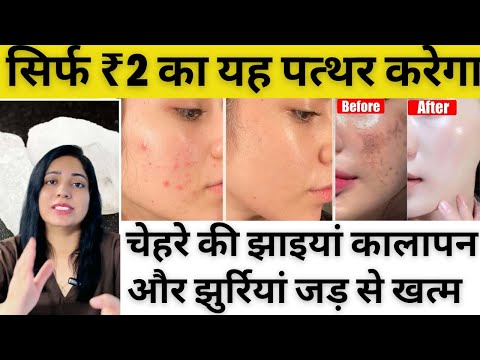 फिटकरी से करे चेहरे की झाइयां, कालापन और झुर्रियां जड़ से ख़त्म | How To Remove Pigmentation At Home |