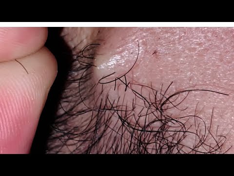REMOVE HAIR INGROWN BERAD ODDLYSATISFYINGVIDEO ASMR RELAXATION VEDIO 207