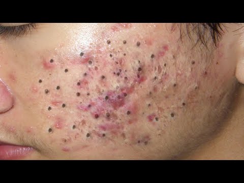 Blackhead Removal With Sac Dep Spa @100074150