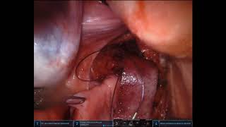 Robotic Ventral Mesh Rectopexy
