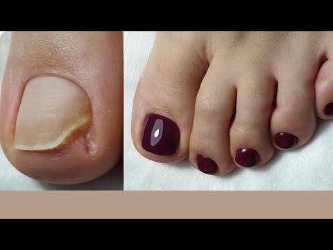 Restoring Missing Toenail 😱 HUGE Pedicure Transformation