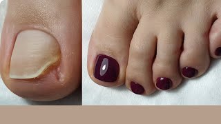 Restoring Missing Toenail 😱 HUGE Pedicure Transformation