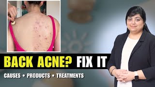 Back Acne Causes, Products & Treatments | Dermatologist Explains